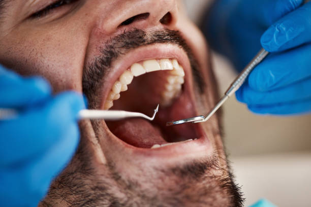 Best Dental Abscess Treatment in Prince George, VA